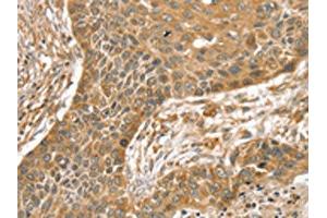 The image on the left is immunohistochemistry of paraffin-embedded Human esophagus cancer tissue using ABIN7192541(SLIT1 Antibody) at dilution 1/35, on the right is treated with synthetic peptide. (SLIT1 antibody)