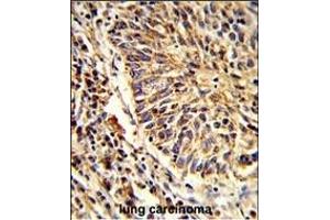 Formalin-fixed and paraffin-embedded human lung carcinoma reacted with AD Antibody (C-term), which was peroxidase-conjugated to the secondary antibody, followed by DAB staining. (ADAM9 antibody  (C-Term))