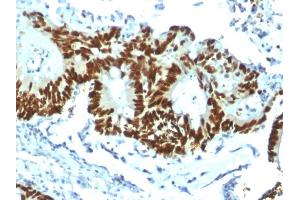 Immunohistochemistry (IHC) image for anti-Tumor Protein P53 (TP53) antibody (ABIN6940791)