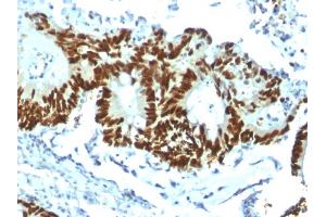Formalin-fixed, paraffin-embedded human Colon Carcinoma stained with p53 Recombinant Rabbit Monoclonal Antibody (TP53/1799R). (Recombinant p53 antibody)