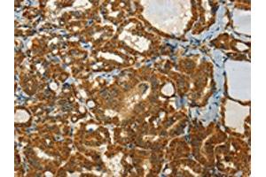The image on the left is immunohistochemistry of paraffin-embedded Human thyroid cancer tissue using ABIN7191682(NPAP1 Antibody) at dilution 1/60, on the right is treated with synthetic peptide. (NPAP1 antibody)