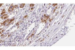 ABIN6272308 at 1/100 staining Human liver cancer tissue by IHC-P. (FFAR3 antibody  (C-Term))