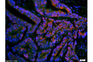 Formalin-fixed and paraffin-embedded human colon carcinoma labeled with Anti-ompF(putative outer membrane porin F protein) Polyclonal Antibody, Unconjugated (ABIN677363) 1:200, overnight at 4°C, The secondary antibody was Goat Anti-Rabbit IgG, Cy3 conjugated used at 1:200 dilution for 40 minutes at 37°C. (Ompf (AA 171-213) antibody)