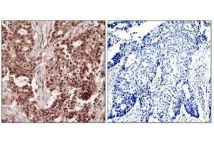 Immunohistochemical analysis of paraffin-embedded human breast carcinoma tissue using NFkB-p105(Phospho-Ser927) Antibody(left) or the same antibody preincubated with blocking peptide(right). (NFKB1 antibody  (pSer927))