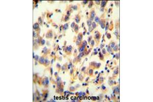 UGT3A2 antibody immunohistochemistry analysis in formalin fixed and paraffin embedded human testis carcinoma followed by peroxidase conjugation of the secondary antibody and DAB staining. (UGT3A2 antibody  (C-Term))