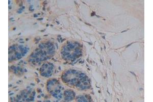 DAB staining on IHC-P; Samples: Human Breast cancer Tissue (Thrombospondin 1 antibody  (AA 24-221))