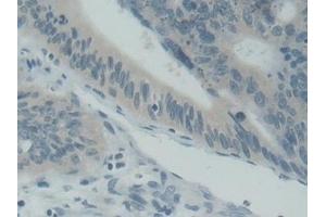 Detection of SNAP25 in Human Stomach cancer Tissue using Polyclonal Antibody to Synaptosomal Associated Protein 25 kDa (SNAP25)