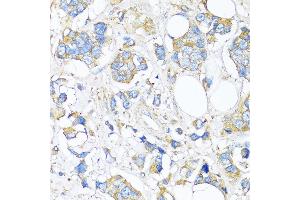 Immunohistochemistry of paraffin-embedded Human breast cancer using TIMP2 antibody (ABIN7268483) at dilution of 1:150 (40x lens).