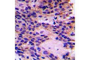 Immunohistochemical analysis of PEX7 staining in human breast cancer formalin fixed paraffin embedded tissue section. (PEX7 antibody  (Center))