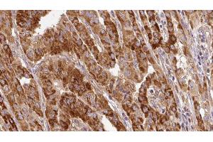 ABIN6267121 at 1/100 staining Human thyroid cancer tissue by IHC-P.