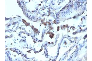 Formalin-fixed, paraffin-embedded human Lung Carcinoma stained with AMACR / p504S Rabbit Polyclonal Antibody. (AMACR antibody)