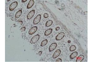 Immunohistochemistry (IHC) analysis of paraffin-embedded Human Colon Carcicnoma using HSP90 alpha Mouse Monoclonal Antibody diluted at 1:200. (HSP90AA2 antibody)