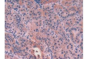 DAB staining on IHC-P; Samples: Human Liver cancer Tissue (KRT8 antibody  (AA 92-393))