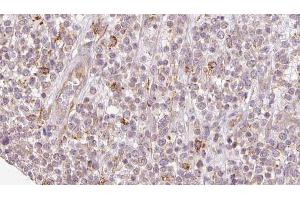 ABIN6273209 at 1/100 staining Human lymph cancer tissue by IHC-P. (SH3KBP1 antibody  (N-Term))