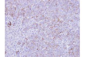 IHC-P Image Immunohistochemical analysis of paraffin-embedded DLD-1 xenograft , using SLC26A8, antibody at 1:500 dilution.