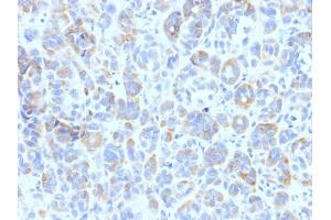 Formalin-fixed, paraffin-embedded human Melanoma stained with TYRP1 Mouse Monoclonal Antibody (TYRP1/807)