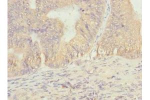 Immunohistochemistry of paraffin-embedded human prostate cancer using ABIN7172901 at dilution of 1:100 (EIF2B1 antibody  (AA 1-305))