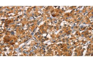 Immunohistochemistry of paraffin-embedded Human thyroid cancer tissue using CDC25B Polyclonal Antibody at dilution 1:45 (CDC25B antibody)