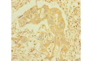 Immunohistochemistry of paraffin-embedded human pancreatic cancer using ABIN7156691 at dilution of 1:100 (IFITM5 antibody  (AA 1-36))