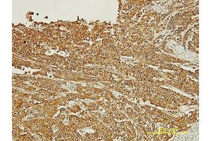 Immunoperoxidase of monoclonal antibody to PDZK1 on formalin-fixed paraffin-embedded human transitional cell carcinoma tissue. (PDZK1 antibody  (AA 1-519))