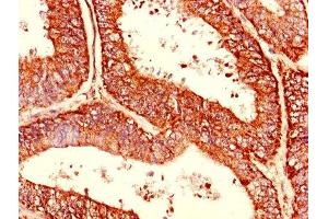 Immunohistochemistry of paraffin-embedded human endometrial cancer using ABIN7174480 at dilution of 1:100 (CDC34 antibody  (AA 1-236))