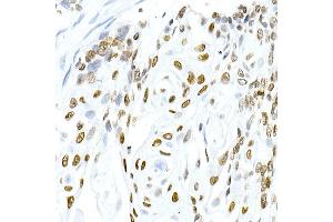 Immunohistochemistry of paraffin-embedded human esophageal cancer using Phospho-Histone H3. (Histone H3.3 antibody  (pSer31))