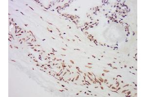 Formalin-fixed and paraffin embedded human prostate labeled with Anti-MST1 Polyclonal Antibody, Unconjugated  at 1:300 followed by conjugation to the secondary antibody and DAB staining. (MST1 antibody  (AA 385-487))