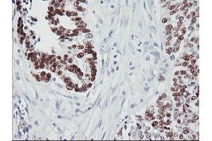 Immunohistochemical staining of paraffin-embedded Adenocarcinoma of Human ovary tissue using anti-TP53 mouse monoclonal antibody. (p53 antibody)