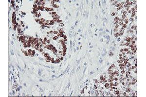 Immunohistochemical staining of paraffin-embedded Adenocarcinoma of Human ovary tissue using anti-TP53 mouse monoclonal antibody. (p53 antibody)