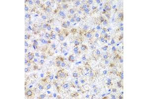 Immunohistochemistry of paraffin-embedded human liver cancer using HAO1 antibody at dilution of 1:200 (400x lens). (HAO1 antibody)