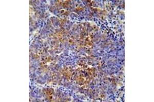 Immunohistochemistry analysis in formalin fixed and paraffin embedded human lung carcinoma reacted with MCAF2 Antibody (Center) Cat.
