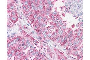 Anti-NEK6 antibody IHC of human Lung, Non-Small Cell Carcinoma.