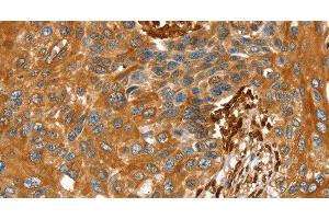 Immunohistochemistry of paraffin-embedded Human esophagus cancer tissue using TAGLN Polyclonal Antibody at dilution 1:30 (Transgelin antibody)