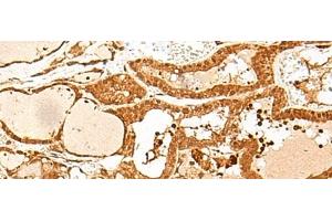 Immunohistochemistry of paraffin-embedded Human thyroid cancer tissue using GTF3C3 Polyclonal Antibody at dilution of 1:30(x200) (GTF3C3 antibody)