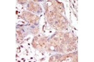 Formalin-fixed and paraffin-embedded human cancer tissue reacted with the primary antibody, which was peroxidase-conjugated to the secondary antibody, followed by DAB staining. (MAK antibody  (C-Term))