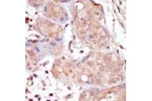Formalin-fixed and paraffin-embedded human cancer tissue reacted with the primary antibody, which was peroxidase-conjugated to the secondary antibody, followed by DAB staining. (MAK antibody  (C-Term))