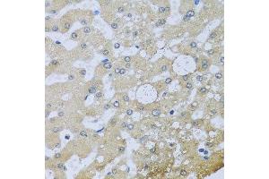 Immunohistochemistry of paraffin-embedded human liver injury using UQCR10 antibody at dilution of 1:100 (x40 lens). (UQCR10 antibody)