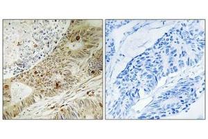 Immunohistochemistry analysis of paraffin-embedded human colon carcinoma tissue, using ATRIP (Phospho-Ser224) antibody. (ATRIP antibody  (pSer224))