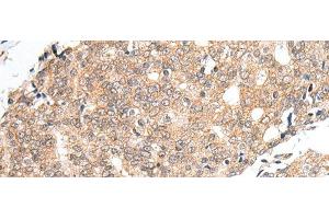 Immunohistochemistry of paraffin-embedded Human prost at e cancer tissue using PRELID1 Polyclonal Antibody at dilution of 1:40(x200) (PRELID1 antibody)