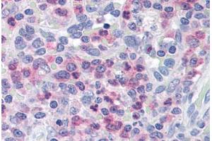Human Spleen (formalin-fixed, paraffin-embedded) stained with UNC13D antibody ABIN290188 at 2. (UNC13D antibody  (AA 1079-1090))