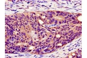 Immunohistochemistry of paraffin-embedded human colon cancer using ABIN7162886 at dilution of 1:100 (PLIN1 antibody  (AA 411-496))