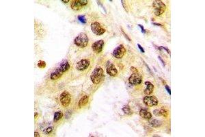 Immunohistochemical analysis of c-Jun staining in human lung cancer formalin fixed paraffin embedded tissue section. (C-JUN antibody)