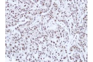 IHC-P Image Immunohistochemical analysis of paraffin-embedded A549 Xenograft, using HNF-1 alpha, antibody at 1:100 dilution. (HNF1A antibody)