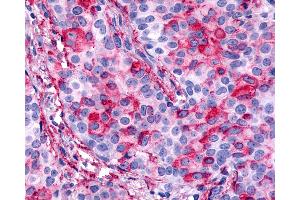 Anti-CELSR1 antibody IHC of human Breast, Carcinoma.