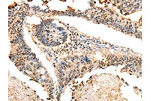 The image on the left is immunohistochemistry of paraffin-embedded Human colon cancer tissue using ABIN7130100(LRP12 Antibody) at dilution 1/25, on the right is treated with fusion protein. (LRP12 antibody)