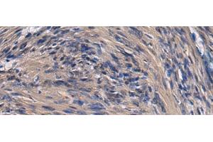 Immunohistochemistry of paraffin-embedded Human brain tissue using ICA1 Polyclonal Antibody at dilution of 1:70(x200) (ICA1 antibody)