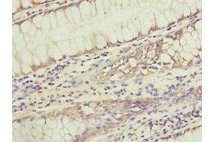 Immunohistochemistry of paraffin-embedded human colon cancer using ABIN7159945 at dilution of 1:100 (KIAA0391 antibody  (Catalytic Subunit))