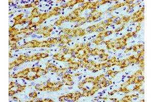 Immunohistochemistry of paraffin-embedded human liver cancer using ABIN7168945 at dilution of 1:100 (AGXT antibody  (AA 112-294))