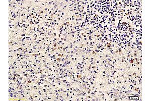 Formalin-fixed and paraffin embedded human cervical carcinoma labeled with Anti-ErbB-3/HER3 Polyclonal Antibody, Unconjugated (ABIN686767) followed by conjugation to the secondary antibody and DAB staining (ERBB3 antibody  (AA 661-760))