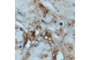 Immunohistochemical analysis of 4EBP1 staining in human prostate cancer formalin fixed paraffin embedded tissue section. (eIF4EBP1 antibody  (N-Term))